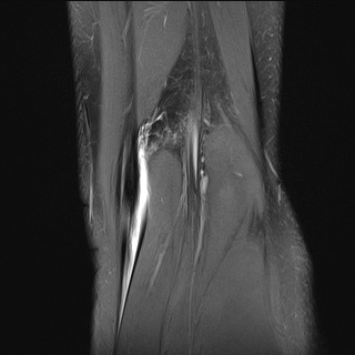 File:Anterior cruciate ligament tear - pediatric (Radiopaedia 62152-70260 Coronal PD fat sat 1).jpg