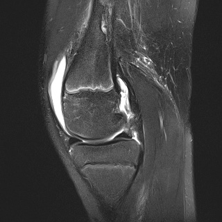 File:Anterior cruciate ligament tear - pediatric (Radiopaedia 62152-70260 Sagittal PD fat sat 14).jpg