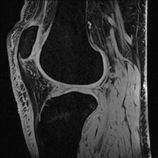 Anterior cruciate ligament tear - ramp lesion (Radiopaedia 71883-82322 Sagittal T1 vibe 55).jpg