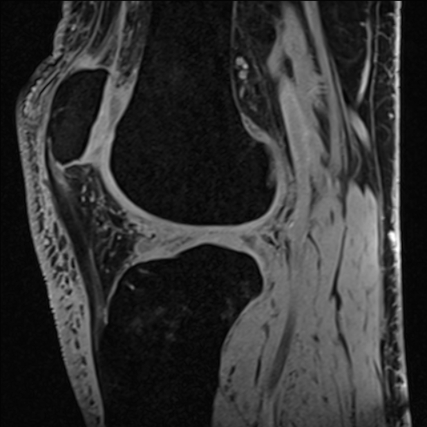 Anterior cruciate ligament tear - ramp lesion (Radiopaedia 71883-82322 Sagittal T1 vibe 58).jpg