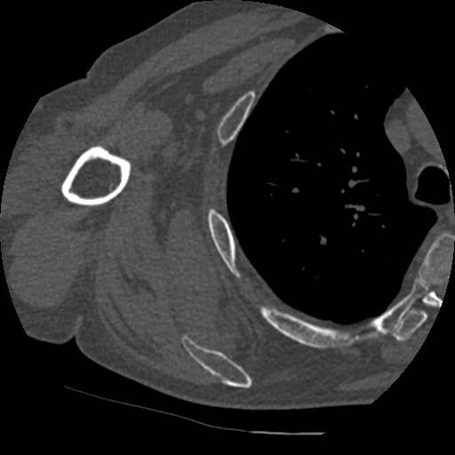Anterior glenohumeral dislocation with Hill-Sachs lesion (Radiopaedia 62877-71249 Axial bone window 69).jpg
