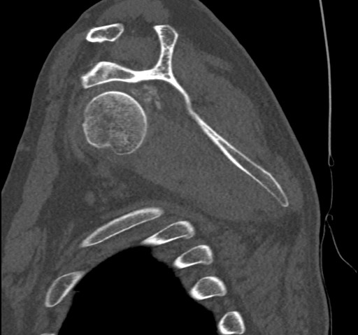 Anterior glenohumeral dislocation with Hill-Sachs lesion (Radiopaedia 62877-71249 Sagittal bone window 38).jpg