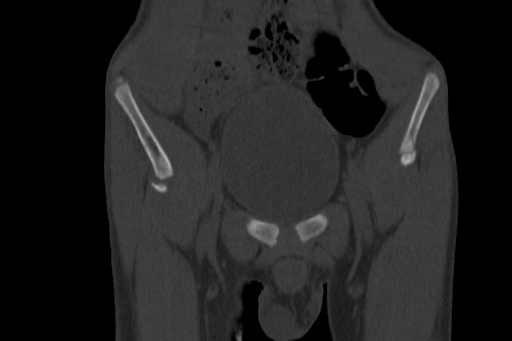 Anterior inferior iliac spine avulsion injury (Radiopaedia 88666-105376 Coronal bone window 17).jpg