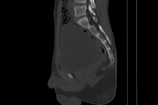 Anterior inferior iliac spine avulsion injury (Radiopaedia 88666-105376 Sagittal bone window 52).jpg