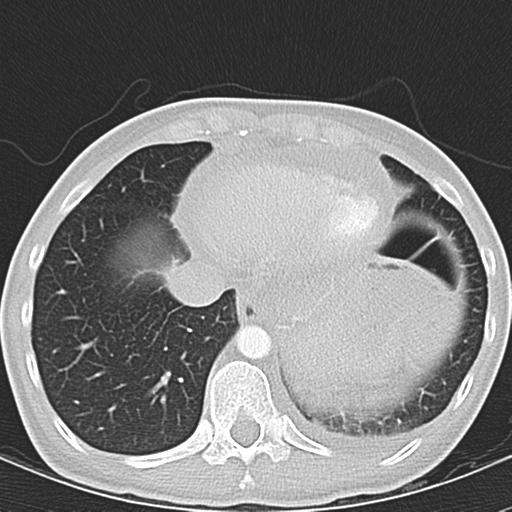 Anterior mediastinal lymphoma (Radiopaedia 29556-30061 Axial lung window 45).jpg