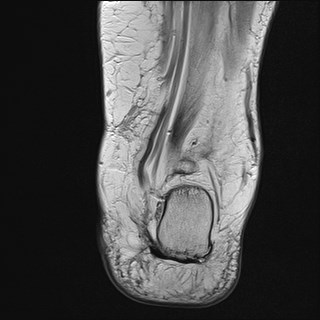 File:Anterior talofibular ligament injury - rupture with soft-tissue impingement (Radiopaedia 38765-40928 Coronal PD 8).jpg