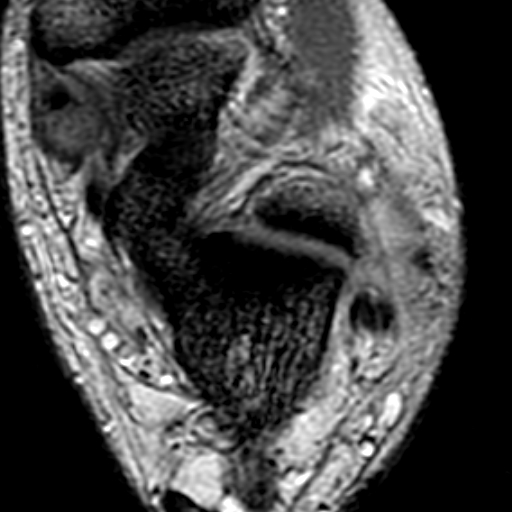 File:Anterior talofibular ligament rupture (Radiopaedia 15831-15484 Axial T2* 15).jpg