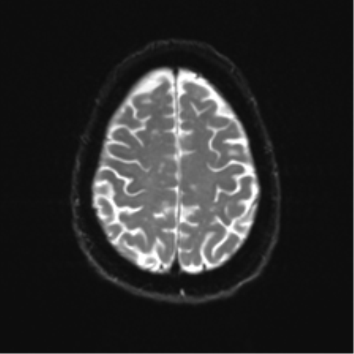 Anterior temporal pole cysts (Radiopaedia 46629-51102 Axial DWI 22).png