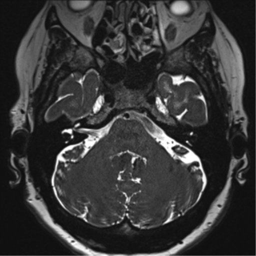 Anterior temporal pole cysts (Radiopaedia 46629-51102 Axial T2 33).png