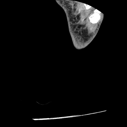 Anterior tibial artery false aneurysm (Radiopaedia 88984-105809 A 274).jpg