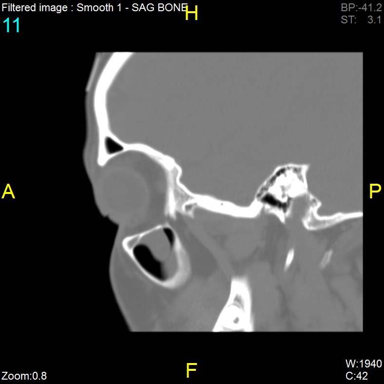 Antrochoanal polyp (Radiopaedia 65101-74094 Sagittal bone window 11).jpg