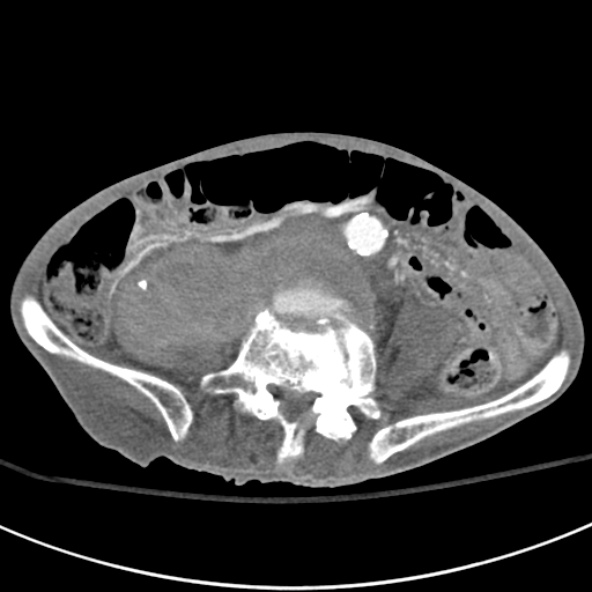 File:Aortic aneurysm with spinal destruction (Radiopaedia 42301-45410 A 68).jpg