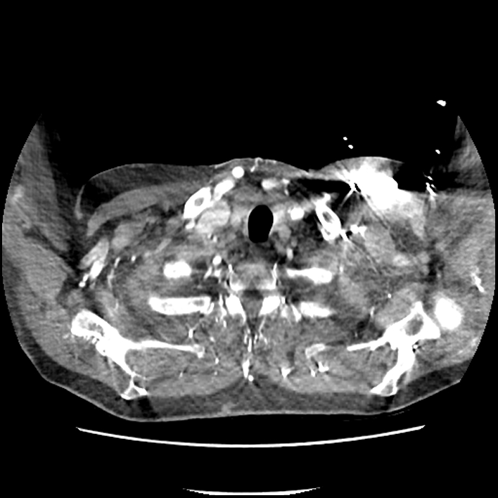 Aortic arch graft infection (FDG PET-CT) (Radiopaedia 71975-82437 A 1).jpg