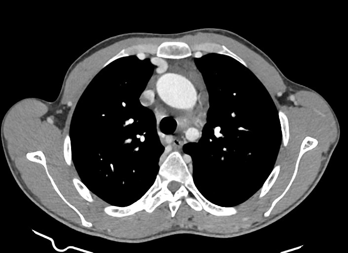 File:Aortic coarctation with aneurysm (Radiopaedia 74818-85828 A 141).jpg