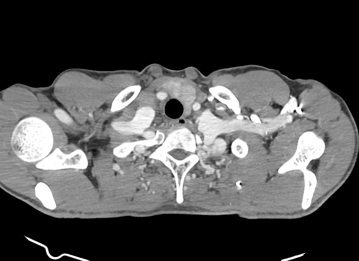 File:Aortic coarctation with aneurysm (Radiopaedia 74818-85828 A 178).jpg