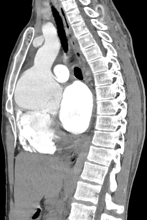 Aortic coarctation with aneurysm (Radiopaedia 74818-85828 B 85).jpg
