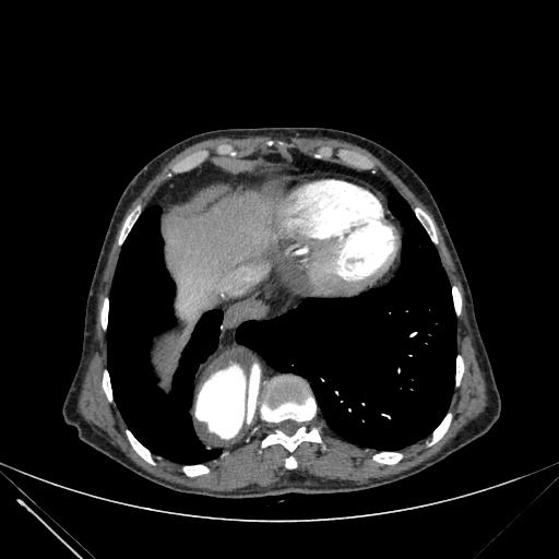 Aortic dissection (Radiopaedia 27466-27665 C+ arterial phase 231).jpg