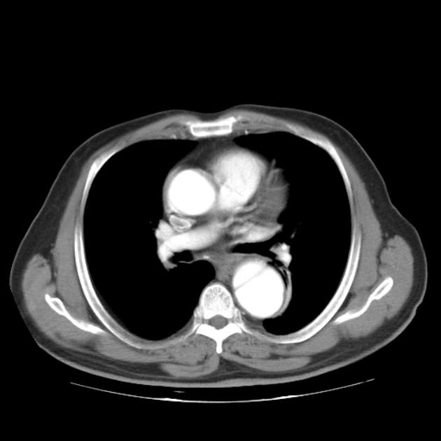 Aortic dissection (Radiopaedia 44411-48061 C 13).jpg