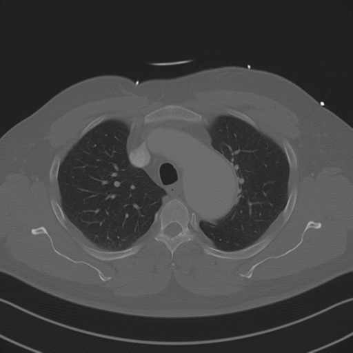 File:Aortic dissection (Radiopaedia 50763-56234 Axial bone window 34).png