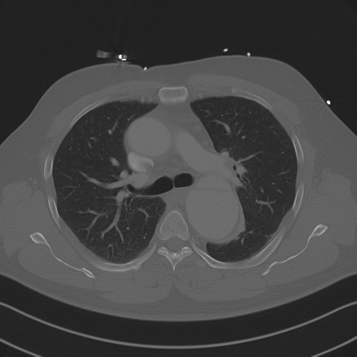 File:Aortic dissection (Radiopaedia 50763-56234 Axial bone window 44).png