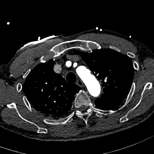 File:Aortic dissection - DeBakey type II (Radiopaedia 64302-73082 A 23).png