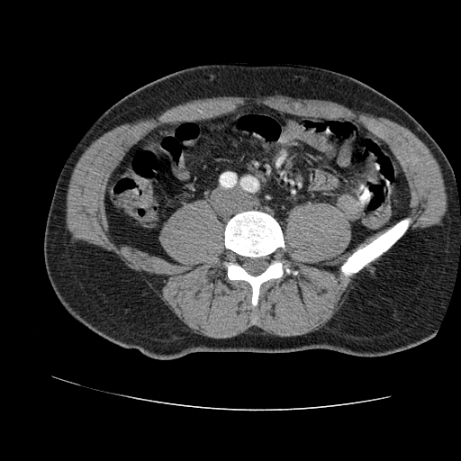 File:Aortic dissection - Stanford A -DeBakey I (Radiopaedia 28339-28587 B 162).jpg