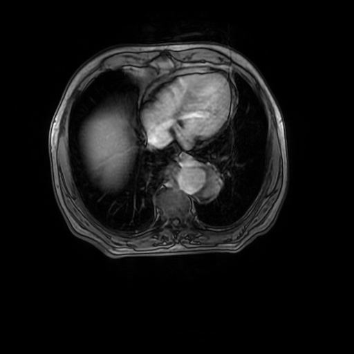 Aortic dissection - Stanford A - DeBakey I (Radiopaedia 23469-23551 Axial MRA 27).jpg