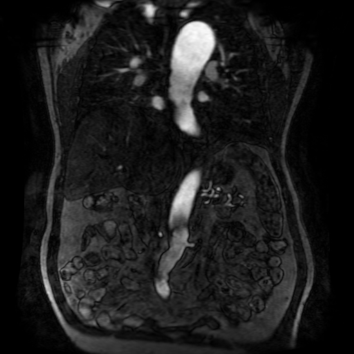 Aortic dissection - Stanford A - DeBakey I (Radiopaedia 23469-23551 D 123).jpg