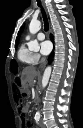 Aortic dissection - Stanford type B (Radiopaedia 73648-84437 C 78).jpg
