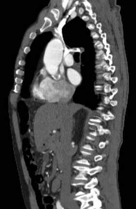 File:Aortic dissection - Stanford type B (Radiopaedia 73648-84437 C 88).jpg