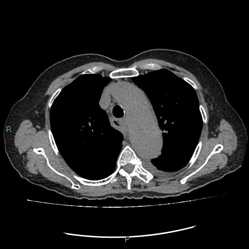 File:Aortic dissection extended to lusory artery (Radiopaedia 43686-47136 Axial non-contrast 9).jpg
