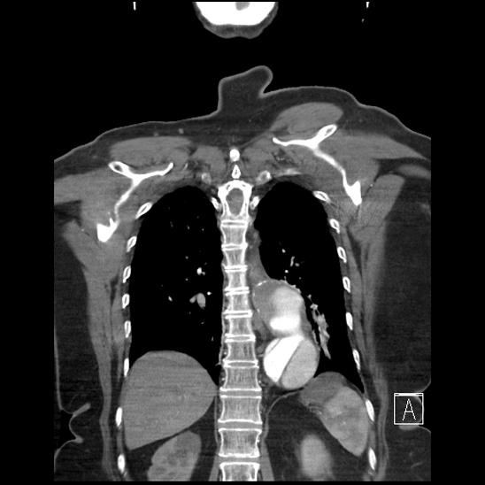 Aortic intramural hematoma with dissection and intramural blood pool (Radiopaedia 77373-89491 C 49).jpg