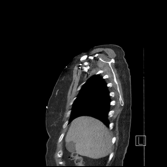 Aortic intramural hematoma with dissection and intramural blood pool (Radiopaedia 77373-89491 D 9).jpg