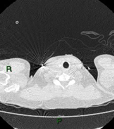 File:Aortic valve endocarditis (Radiopaedia 87209-103485 Axial lung window 2).jpg
