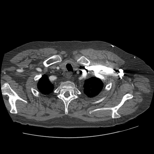 File:Aorto-coronary bypass graft aneurysms (Radiopaedia 40562-43157 A 17).png