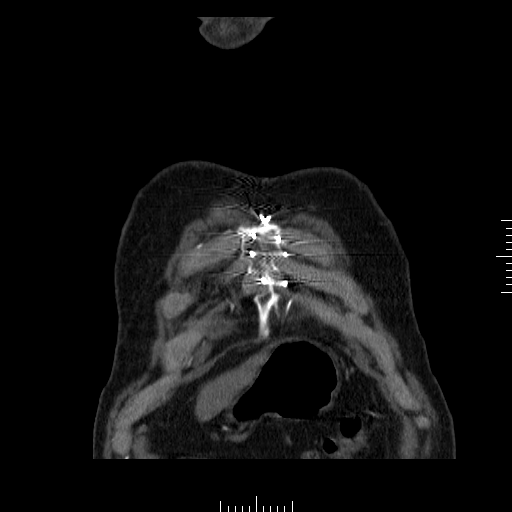 File:Aorto-coronary bypass graft aneurysms (Radiopaedia 40562-43157 B 1).png