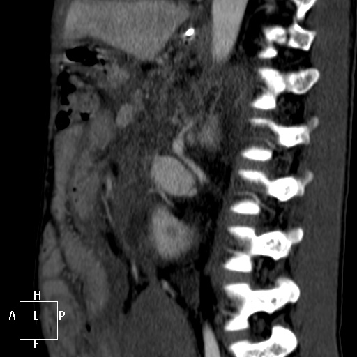 File:Aorto-left renal vein fistula (Radiopaedia 45534-49628 C 44).jpg