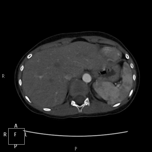 File:Aortopulmonary septal defect (Radiopaedia 41990-45013 Axial C+ CTPA 3).jpg