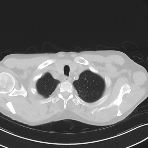 Apical pulmonary metastasis (Radiopaedia 46338-50754 Axial non-contrast 10).png