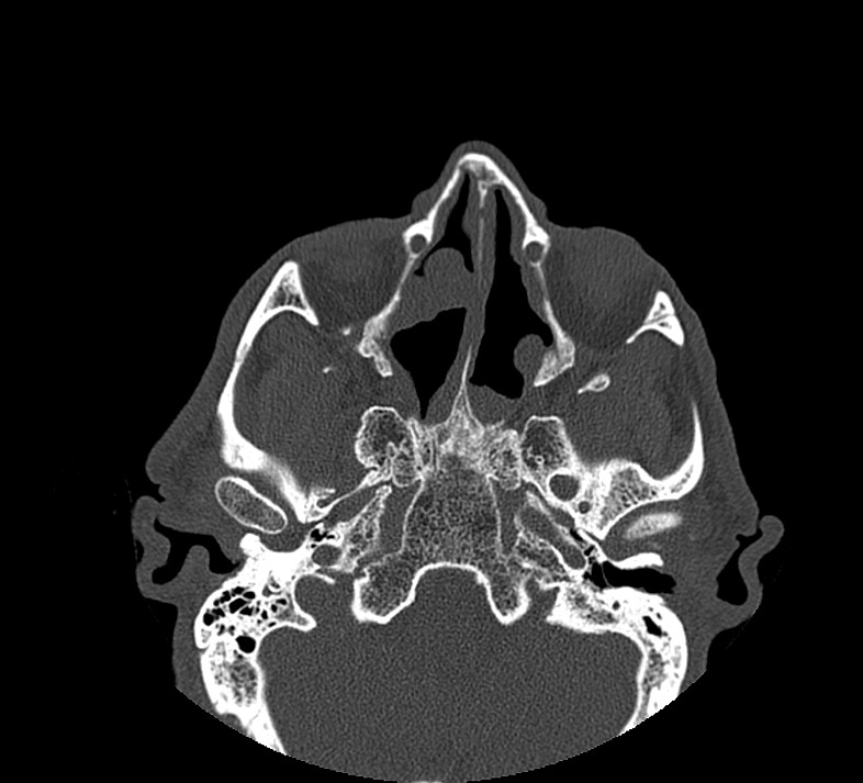 Aplastic maxillary sinuses (Radiopaedia 60030-67561 Axial non-contrast 37).jpg