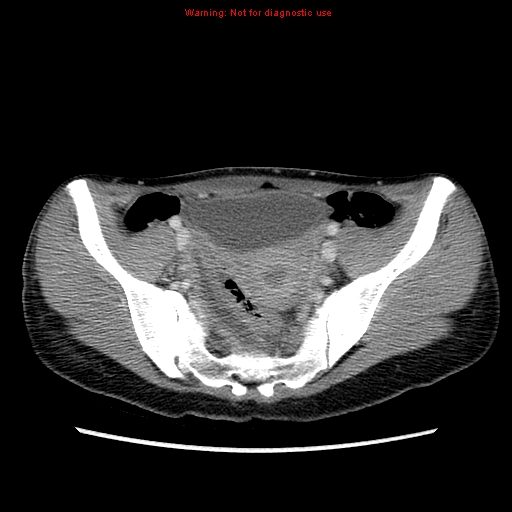 File:Appendiceal abscess (Radiopaedia 13096-13151 A 4).jpg