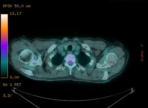 Appendiceal adenocarcinoma complicated by retroperitoneal abscess (Radiopaedia 58007-65041 Axial PET-CT 33).jpg
