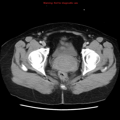 Appendiceal mucinous cystadenoma (Radiopaedia 8263-9111 Axial liver window 76).jpg