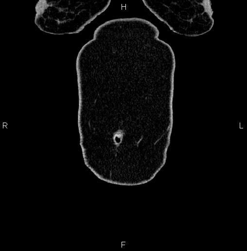 Appendiceal mucocele (Radiopaedia 82952-97298 C 4).jpg