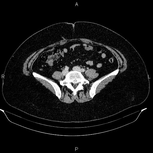 Appendiceal mucocele (Radiopaedia 83280-97688 Axial With contrast 72).jpg
