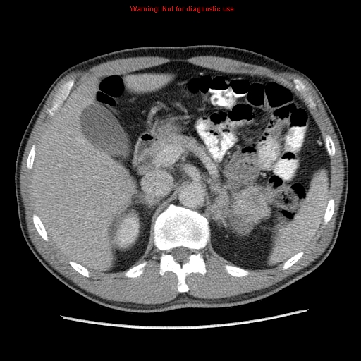File:Appendicitis and renal cell carcinoma (Radiopaedia 17063-16760 A 16).jpg