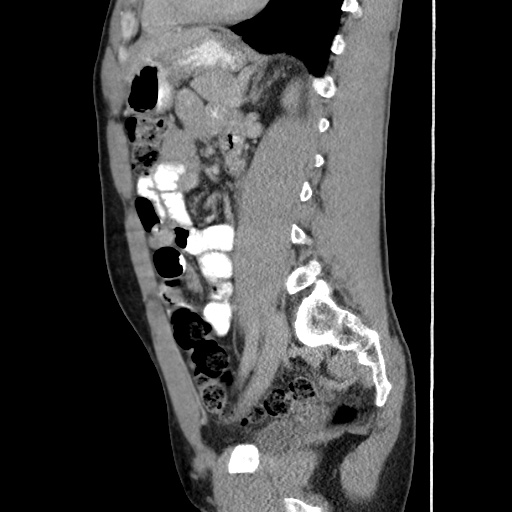 Appendicitis complicated by post-operative collection (Radiopaedia 35595-37114 C 45).jpg