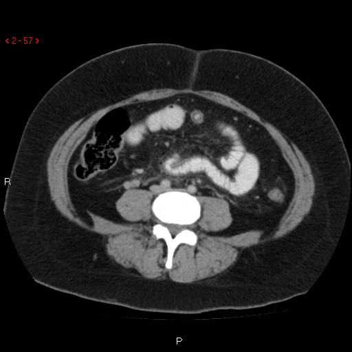 File:Appendicitis with microperforation- promontoric type (Radiopaedia 27268-27442 C 45).jpg