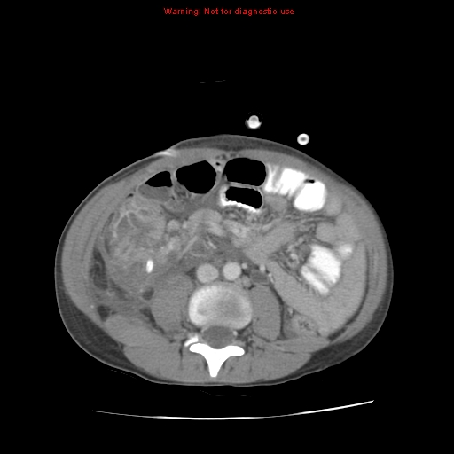 File:Appendicitis with phlegmon (Radiopaedia 9358-10046 A 41).jpg