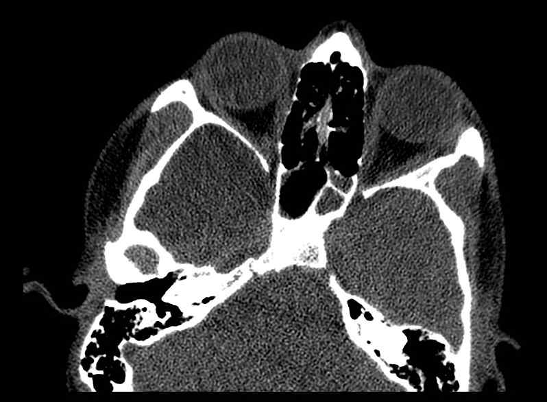 Arachnoid cyst- extremely large (Radiopaedia 68741-78450 Axial bone window 18).jpg